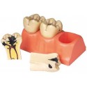 DISSECTED MODEL OF DENTAL CARIES